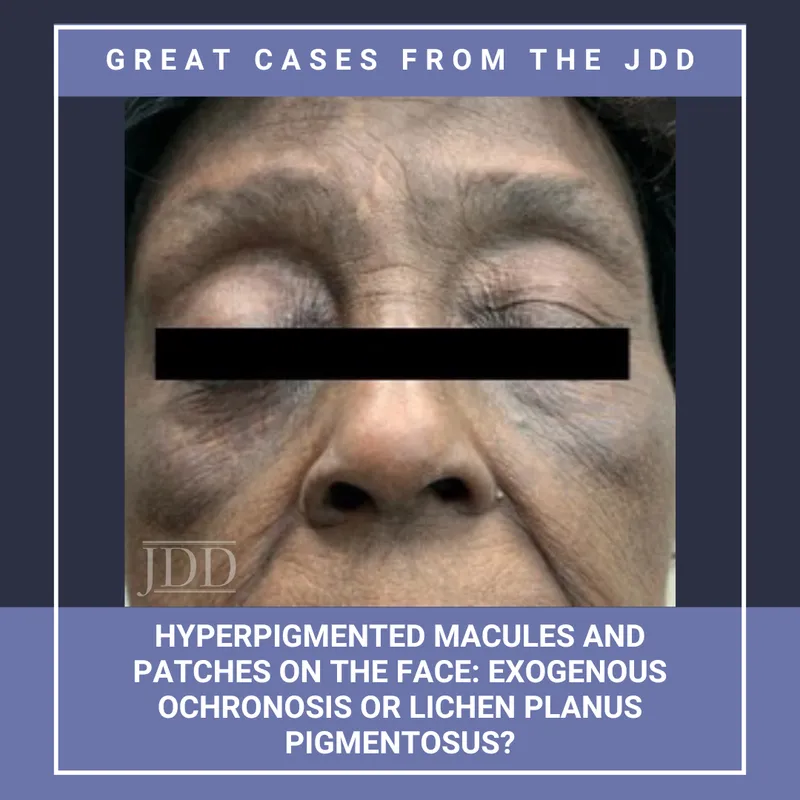Chemical-induced pigmentary changes showing ochronosis and contact patterns