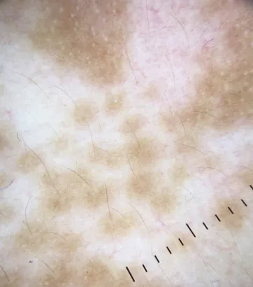 Dermoscopic features of vitiligo showing perifollicular pigmentation patterns