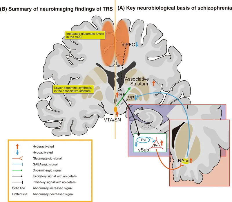 Brain imaging showing dopaminergic pathways in schizophrenia