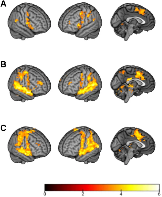 Neuroimaging showing brain activation patterns during auditory hallucinations