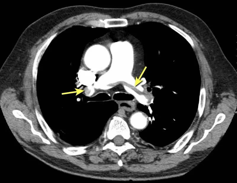 Figure 1: CT pulmonary angiography showing filling defect in right pulmonary artery