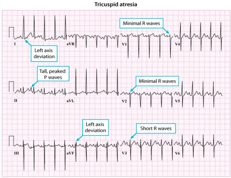 Figure 2: ECG showing sinus tachycardia with S1Q3T3 pattern