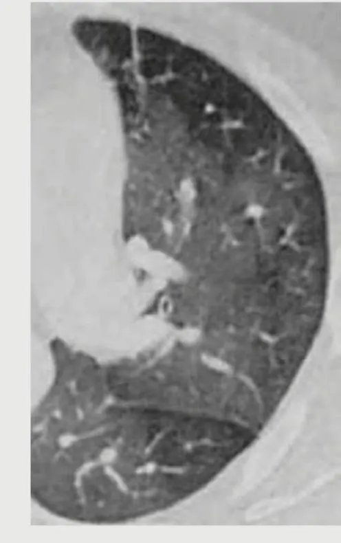 interstitial lung disease hrct
