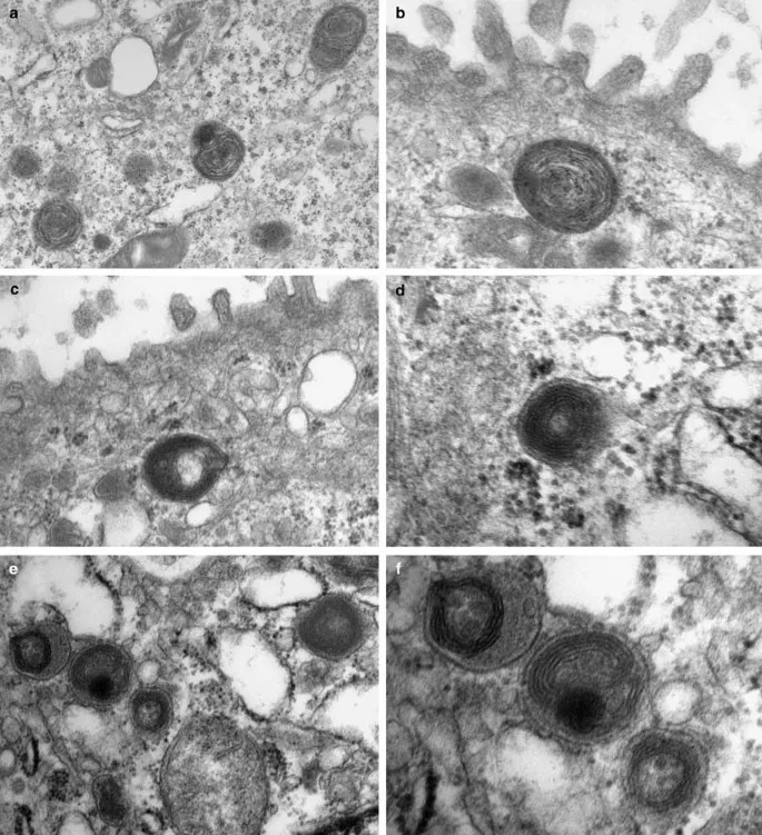 Electron microscopy of type II pneumocyte showing lamellar bodies and surfactant production