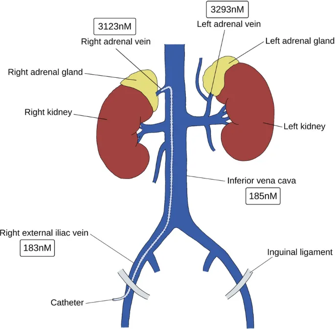 Adrenal venous sampling procedure showing catheter placement