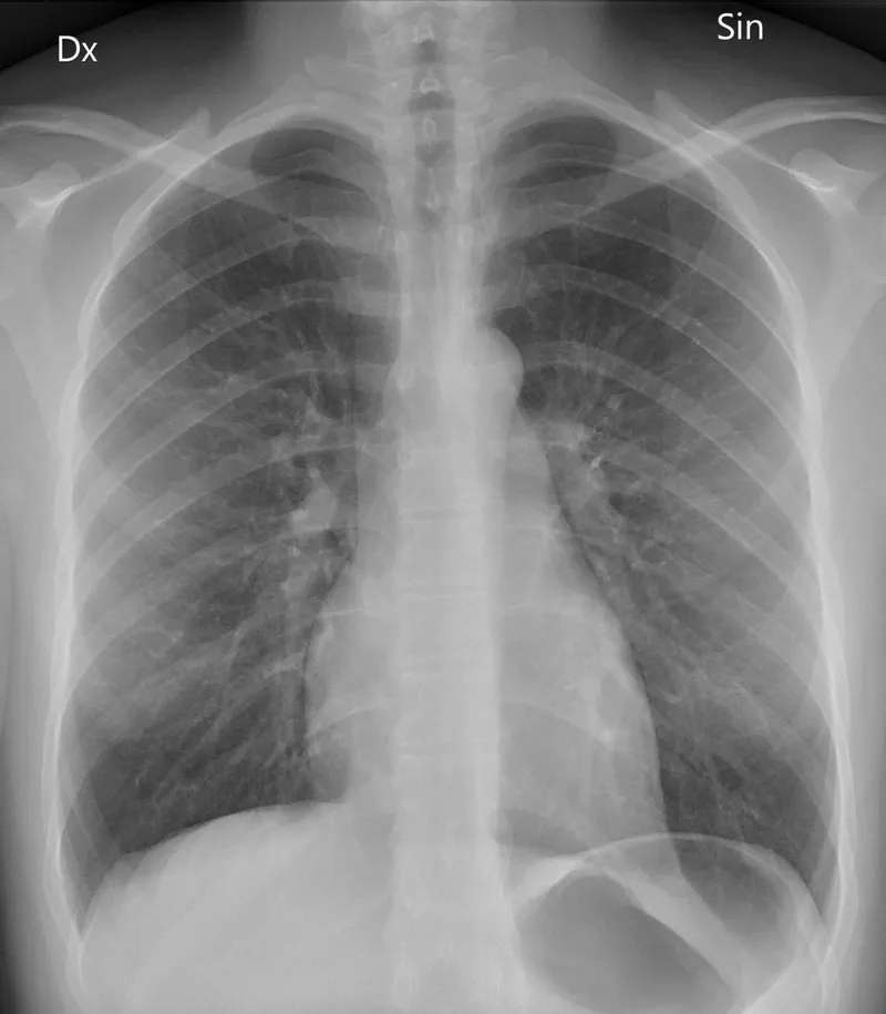 Standard PA chest X-ray with comprehensive anatomical landmark overlay