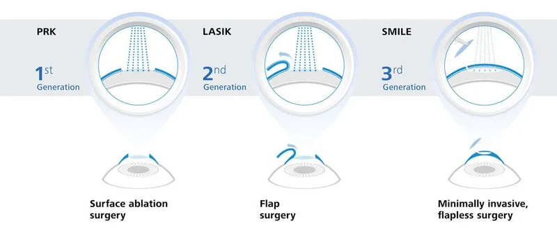 Comprehensive refractive surgery procedure comparison showing LASIK, PRK, and SMILE techniques