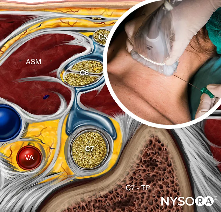 Anatomical diagram showing brachial plexus nerve distribution and block approach levels