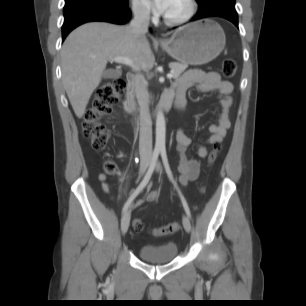 Figure 2: Non-contrast CT KUB showing 6mm radiopaque calculus in right mid-ureter with proximal hydroureter