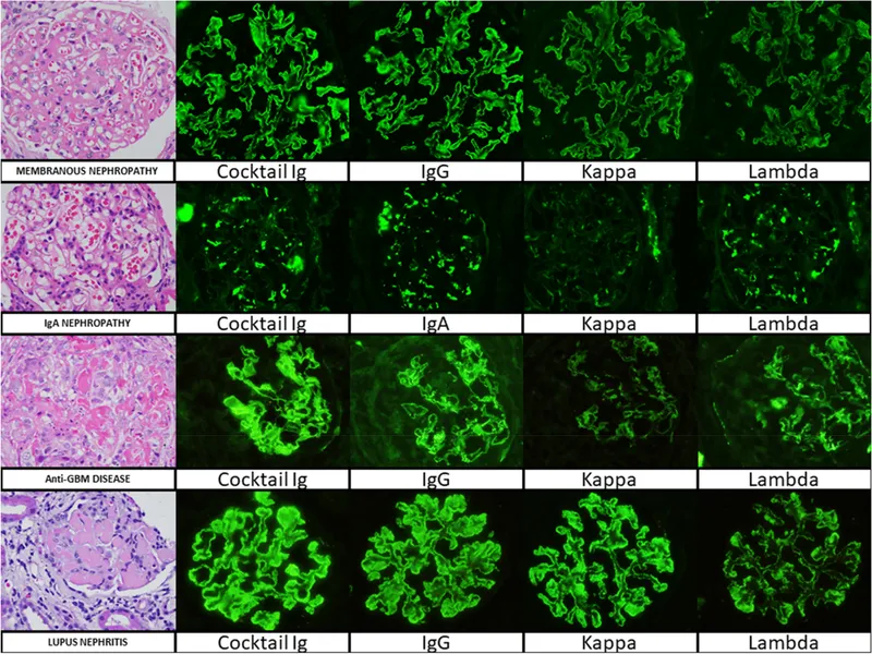 Immunofluorescence patterns in glomerulonephritis showing different deposition patterns