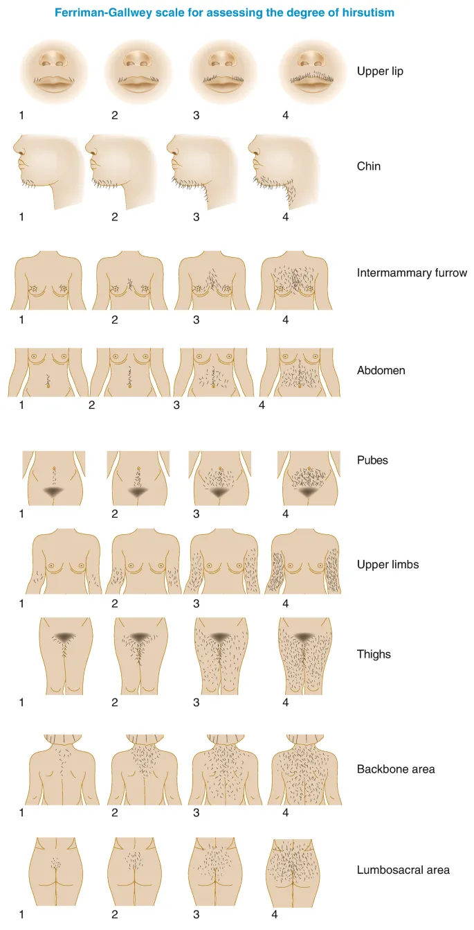 hirsutism clinical photograph