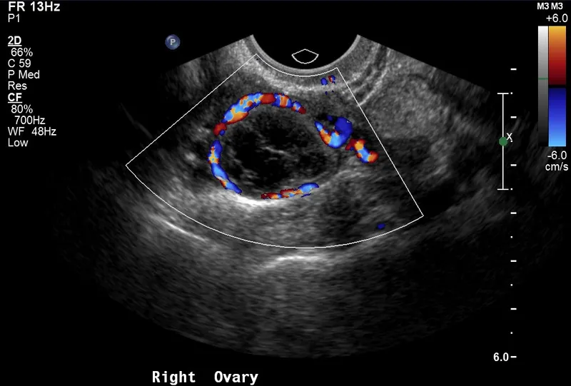 Ultrasound image of corpus luteum with characteristic ring of fire vascularity