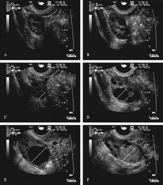 Graph showing follicle size progression during menstrual cycle