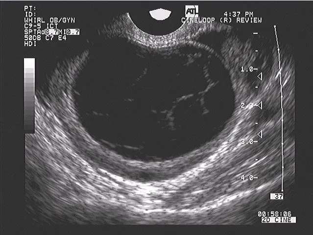 Ultrasound image showing dominant follicle before ovulation