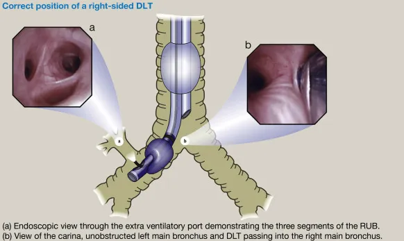 Bronchoscopic view of carina and main bronchi anatomy