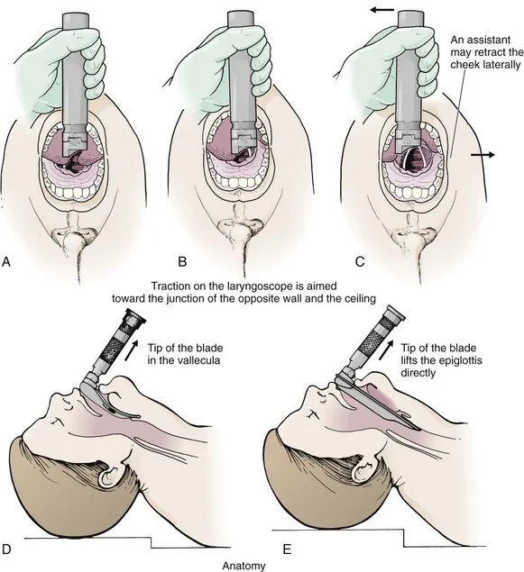 Pediatric laryngoscopy technique showing straight blade positioning