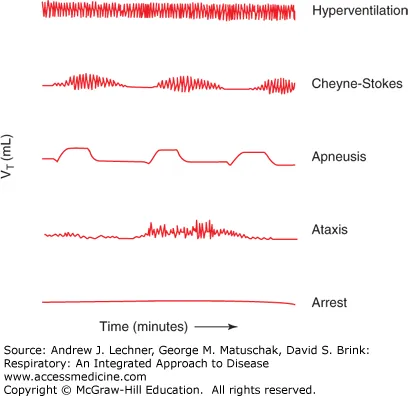 Breathing pattern waveforms showing normal vs pontine lesion patterns