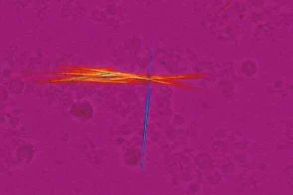 Figure 1: Polarized light microscopy showing needle-shaped negatively birefringent monosodium urate crystals in synovial fluid from gout