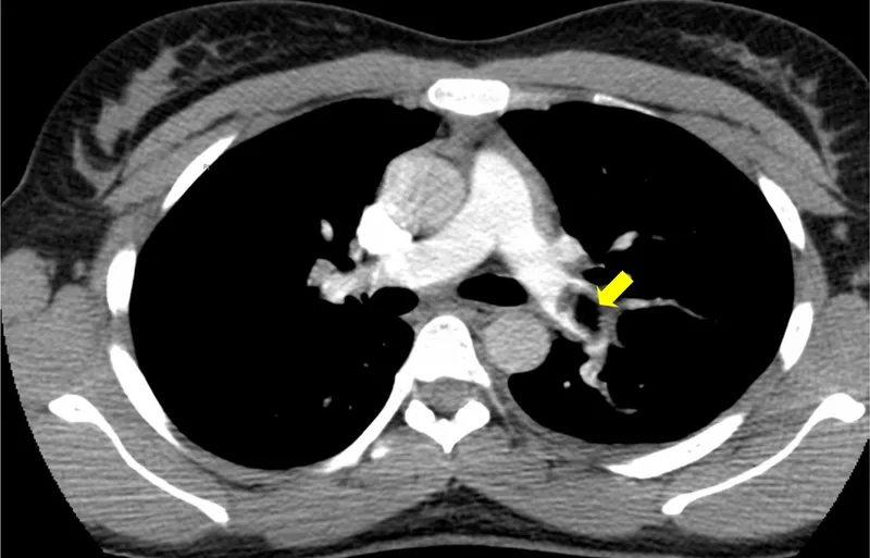 Figure 4: CTPA showing filling defect in right pulmonary artery indicating pulmonary embolism