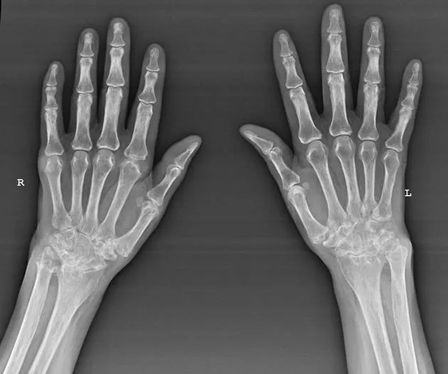 Figure 2: X-ray hands showing periarticular erosions and joint space narrowing in rheumatoid arthritis