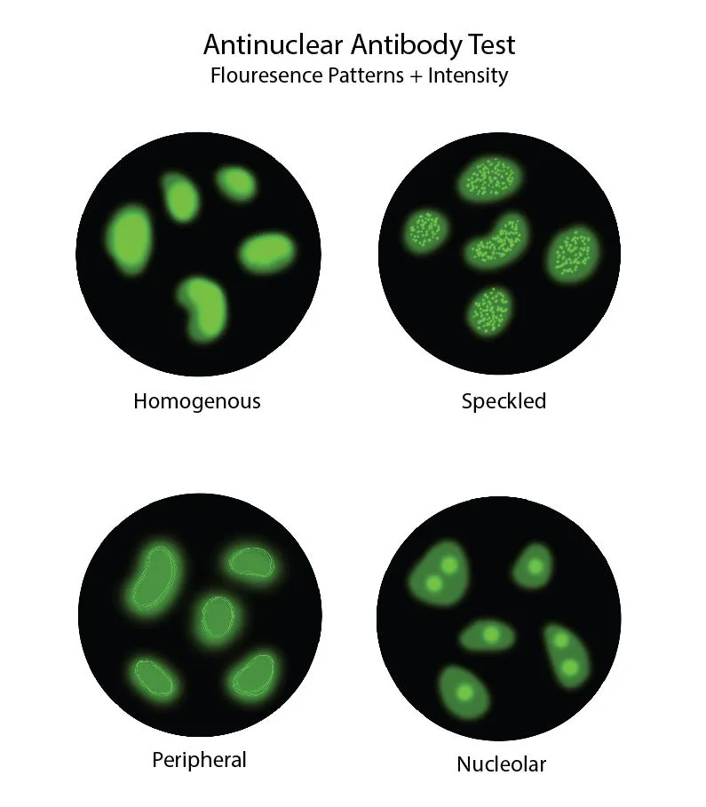 Autoantibody testing laboratory with ANA, anti-CCP, RF immunofluorescence patterns