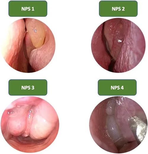Endoscopic grading system for nasal polyps with visual examples