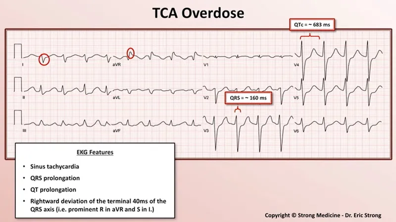 Figure 2: ECG showing prolonged QTc interval in patient on antipsychotic medication