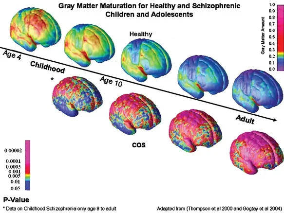 Neurodevelopmental timeline showing critical periods in schizophrenia