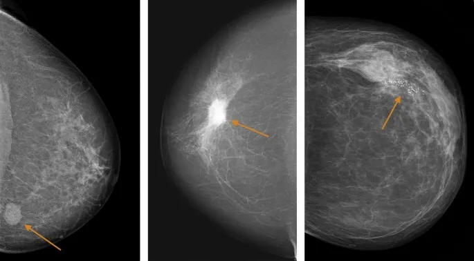 Figure 1: Two-view mammogram showing stellate mass with spiculated margins characteristic of invasive ductal carcinoma