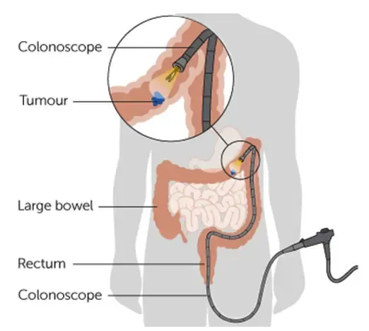 Endoscopic screening procedures and their diagnostic accuracy