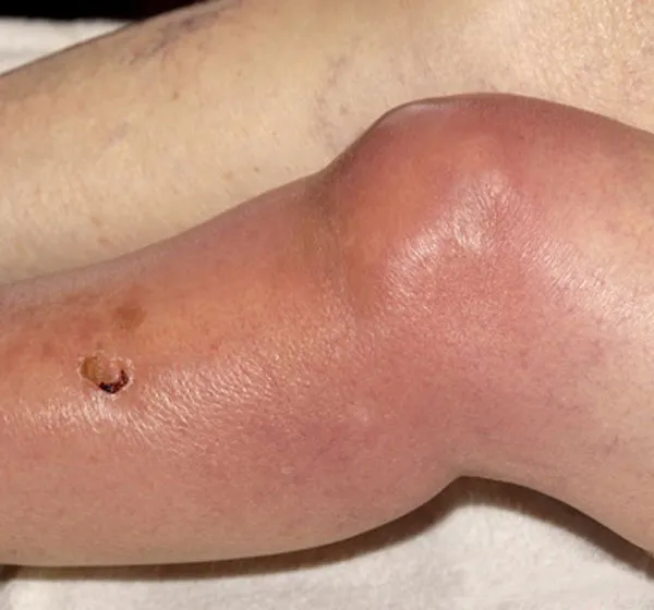 Figure 1: Clinical photograph showing sharply demarcated raised erythematous plaque on lower leg
