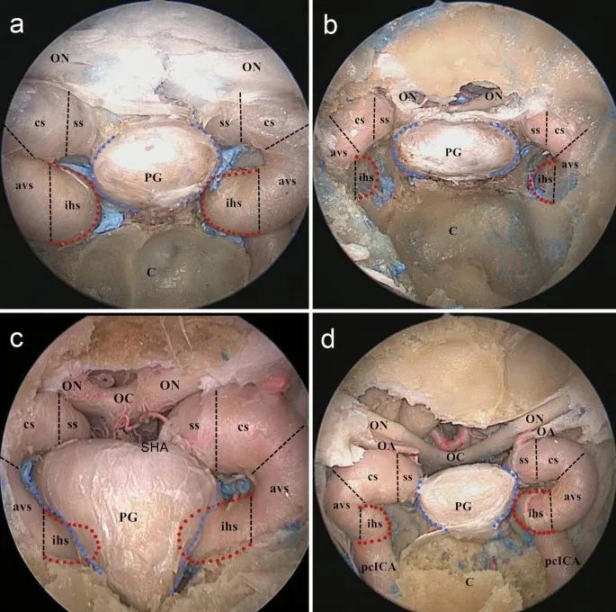 Endoscopic view of skull base anatomy during transsphenoidal approach