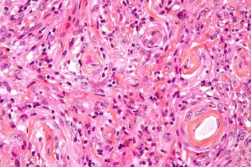 Histopathological image of meningioma showing characteristic whorled pattern