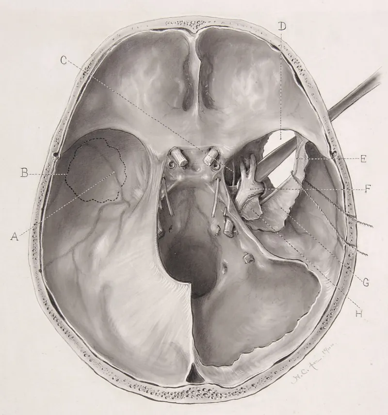 Intraoperative microscopic view of skull base surgery showing delicate tissue dissection