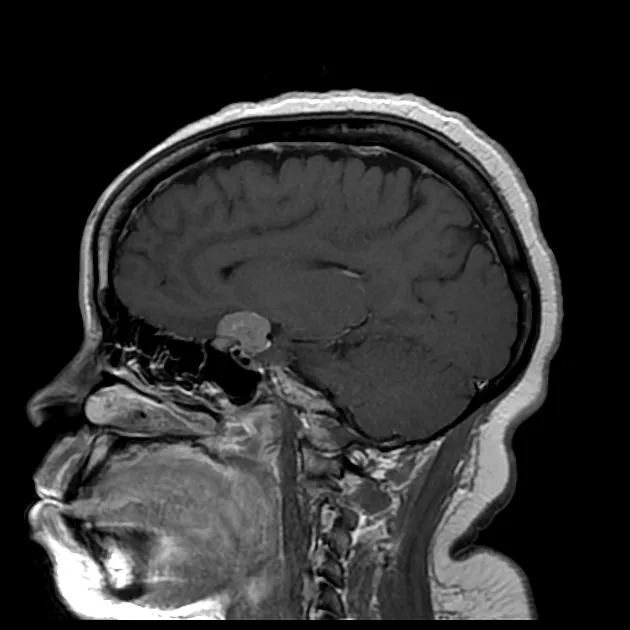 Comparative MRI images showing different skull base tumors with characteristic features
