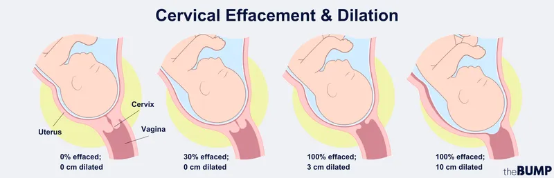 Detailed cervical effacement and dilation progression diagram