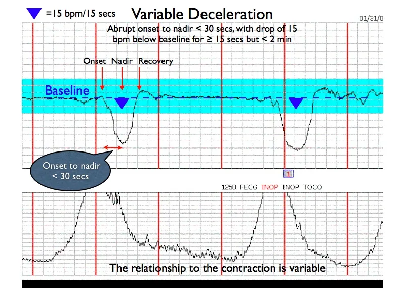 Fetal heart rate tracing examples showing different categories