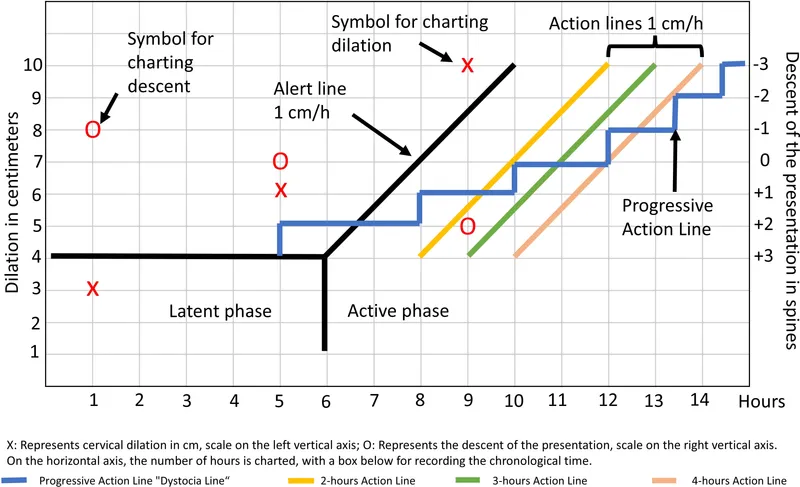 Comparison chart of normal versus abnormal labor progression patterns
