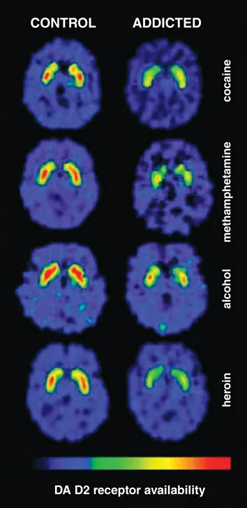 addiction brain changes