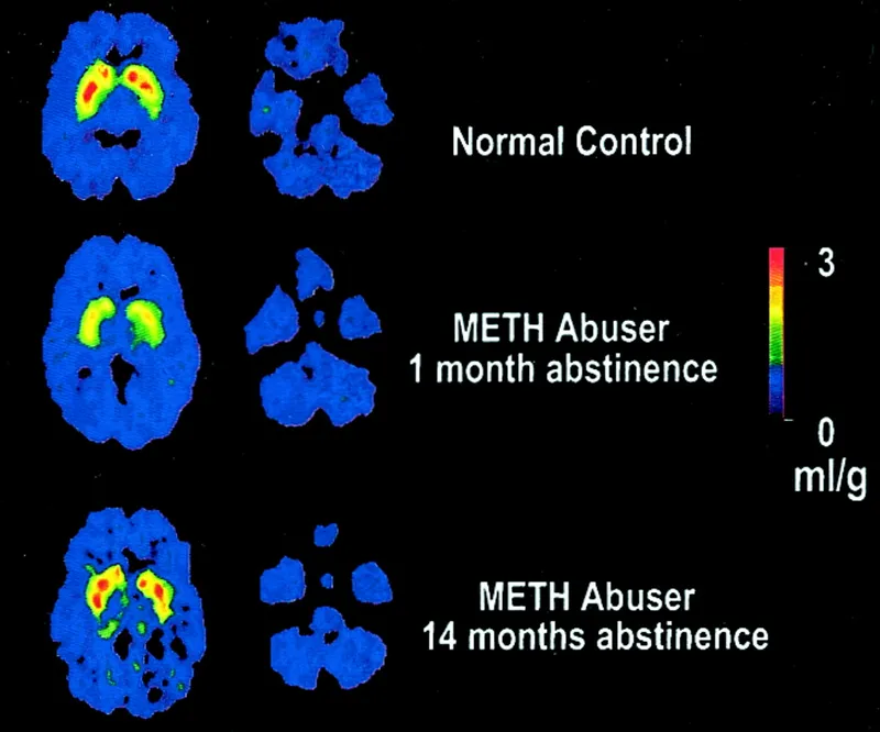 Brain scans comparing normal vs methamphetamine-damaged brain tissue