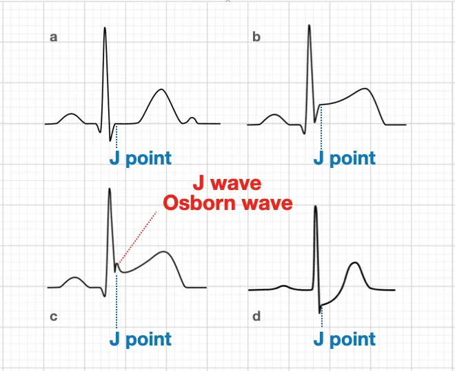 ECG showing Osborn J waves characteristic of severe hypothermia