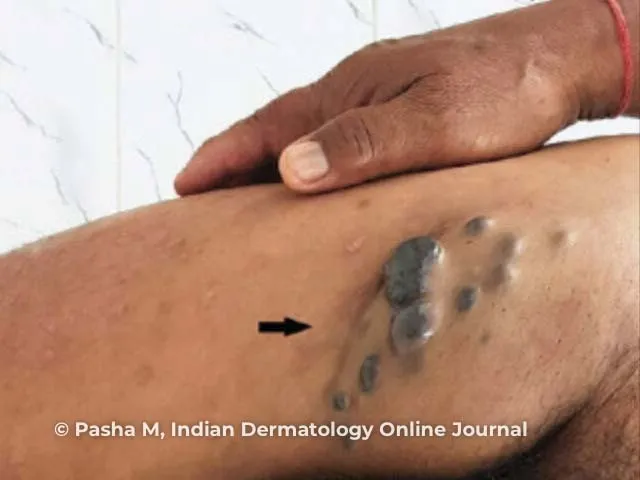 Clinical photographs showing different nodular tropical skin diseases