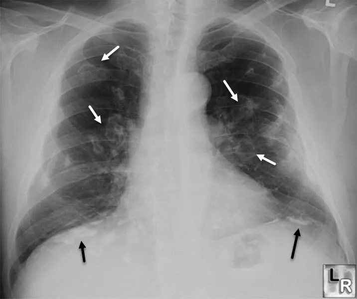 Figure 1: Chest X-ray showing upper lobe cavitation and patchy consolidation