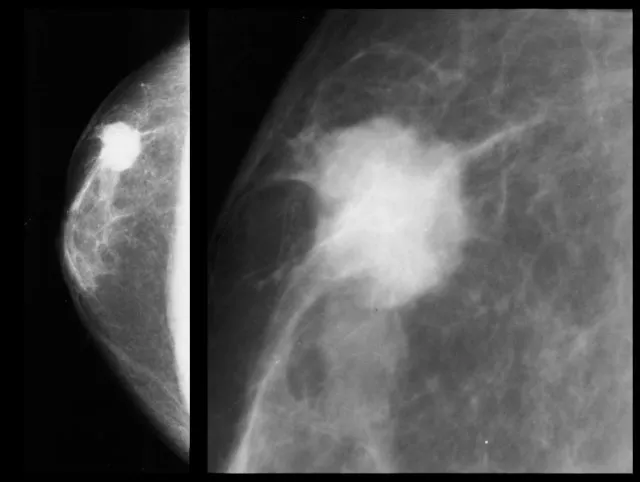 Figure 1: Mammogram showing spiculated mass with microcalcifications