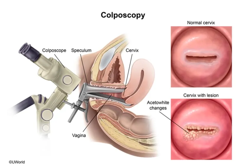 Figure 2: Colposcopy image showing acetowhite epithelium at transformation zone