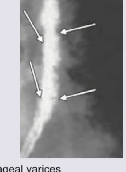 Figure 2: Endoscopy showing oesophageal varices with red whale markings