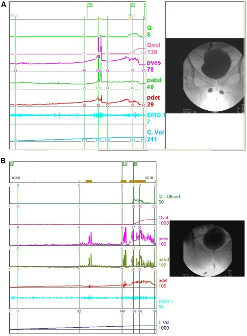 Pressure-flow study showing normal versus obstructed voiding patterns