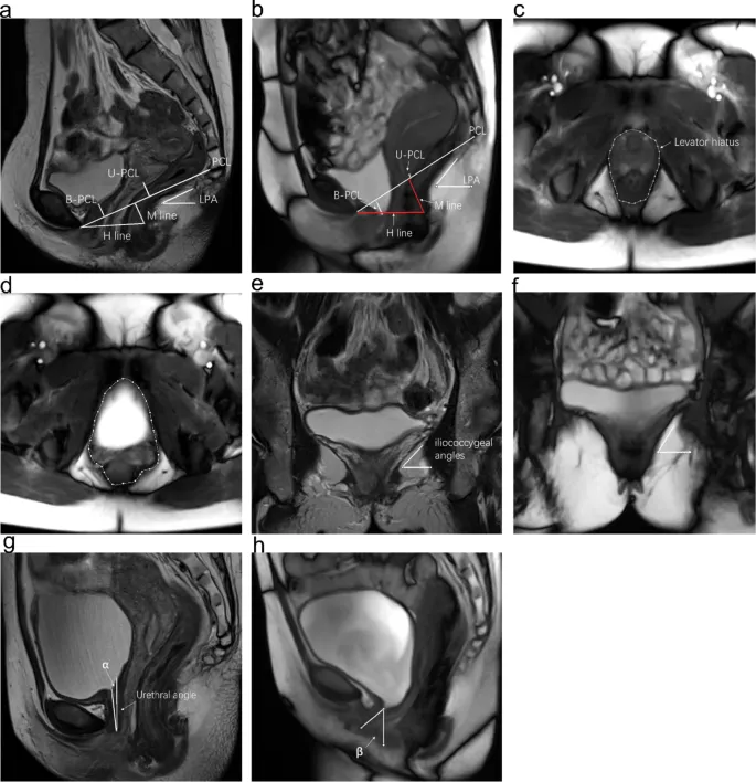 Sagittal MRI showing multilevel pelvic organ prolapse with measurement annotations