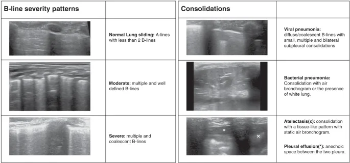 Point-of-care ultrasound showing lung pathology causing V/Q mismatch