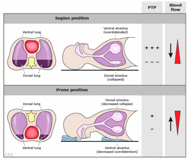 Prone positioning technique showing improved V/Q matching in ARDS patient
